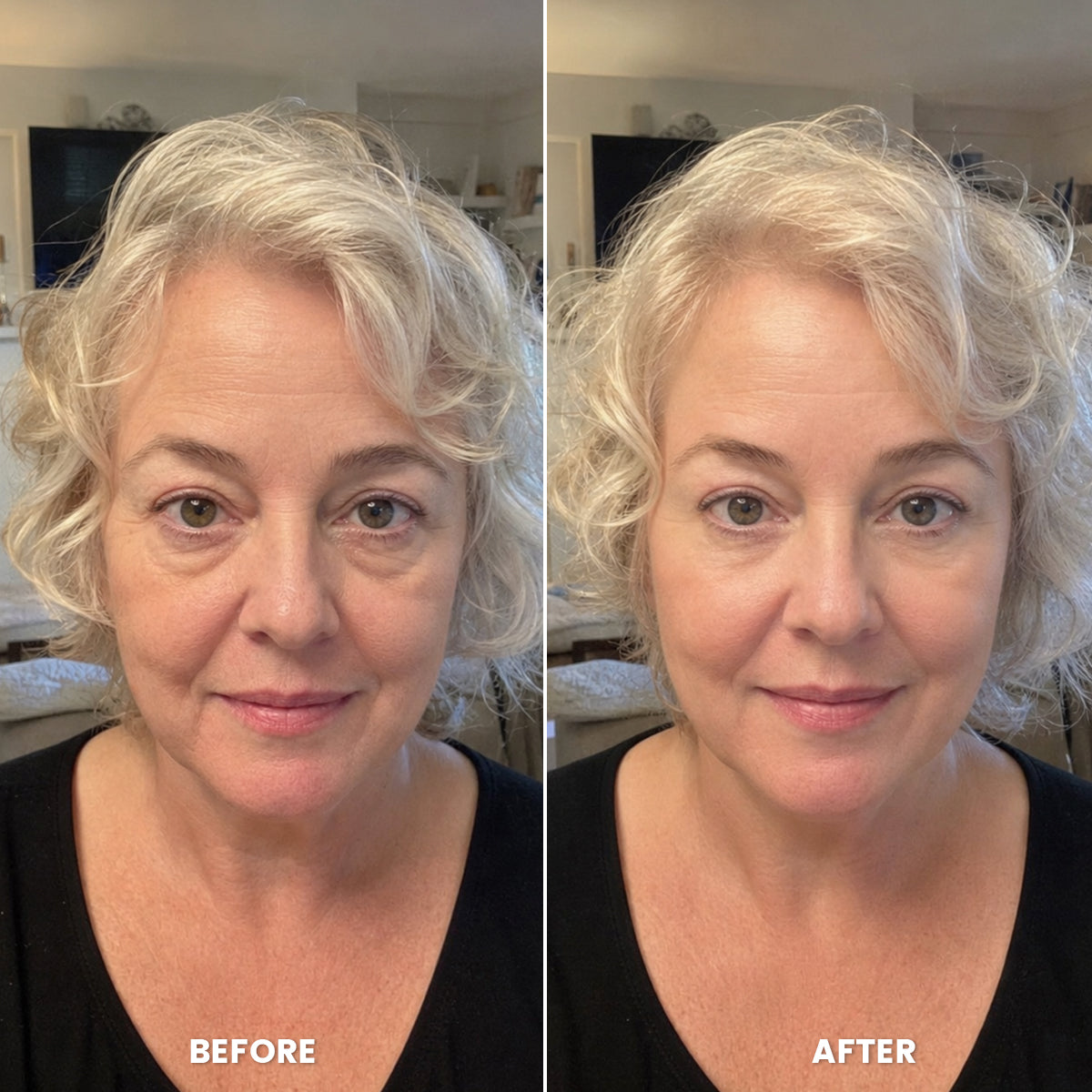 Before and after under-eye bags