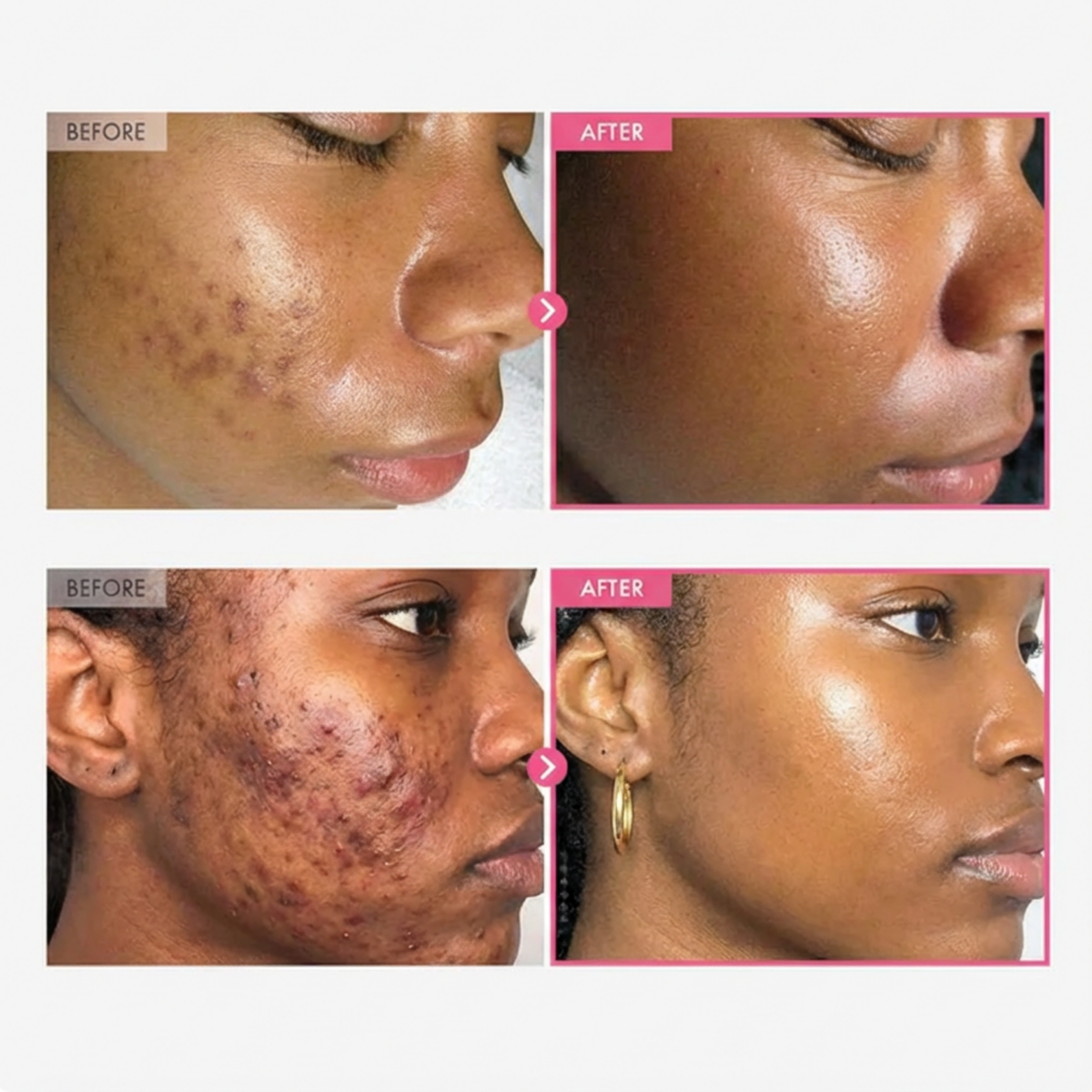 Arbutin 7% + Tranexamic Acid 4% Cream