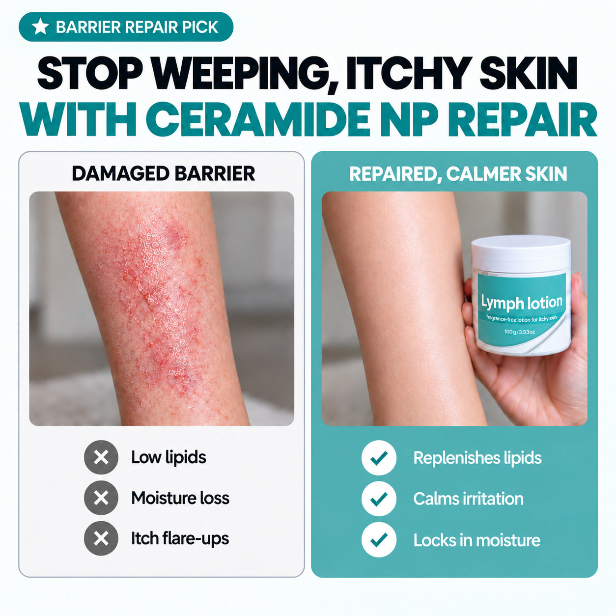 Fragrance-Free Non-Greasy Anti-Itch Ceramide NP Leg Lotion For Dry, Red, Sensitive, Discolored, Weeping
