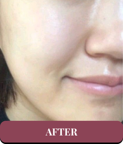 After treatment
