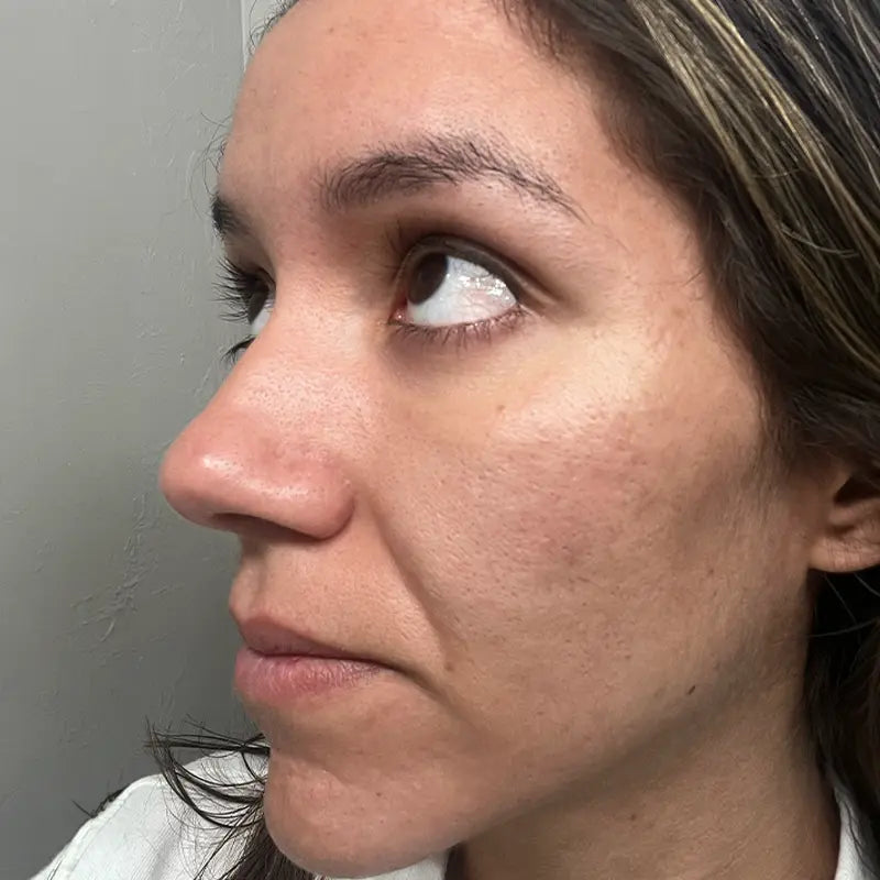 Skin after eight to twelve weeks