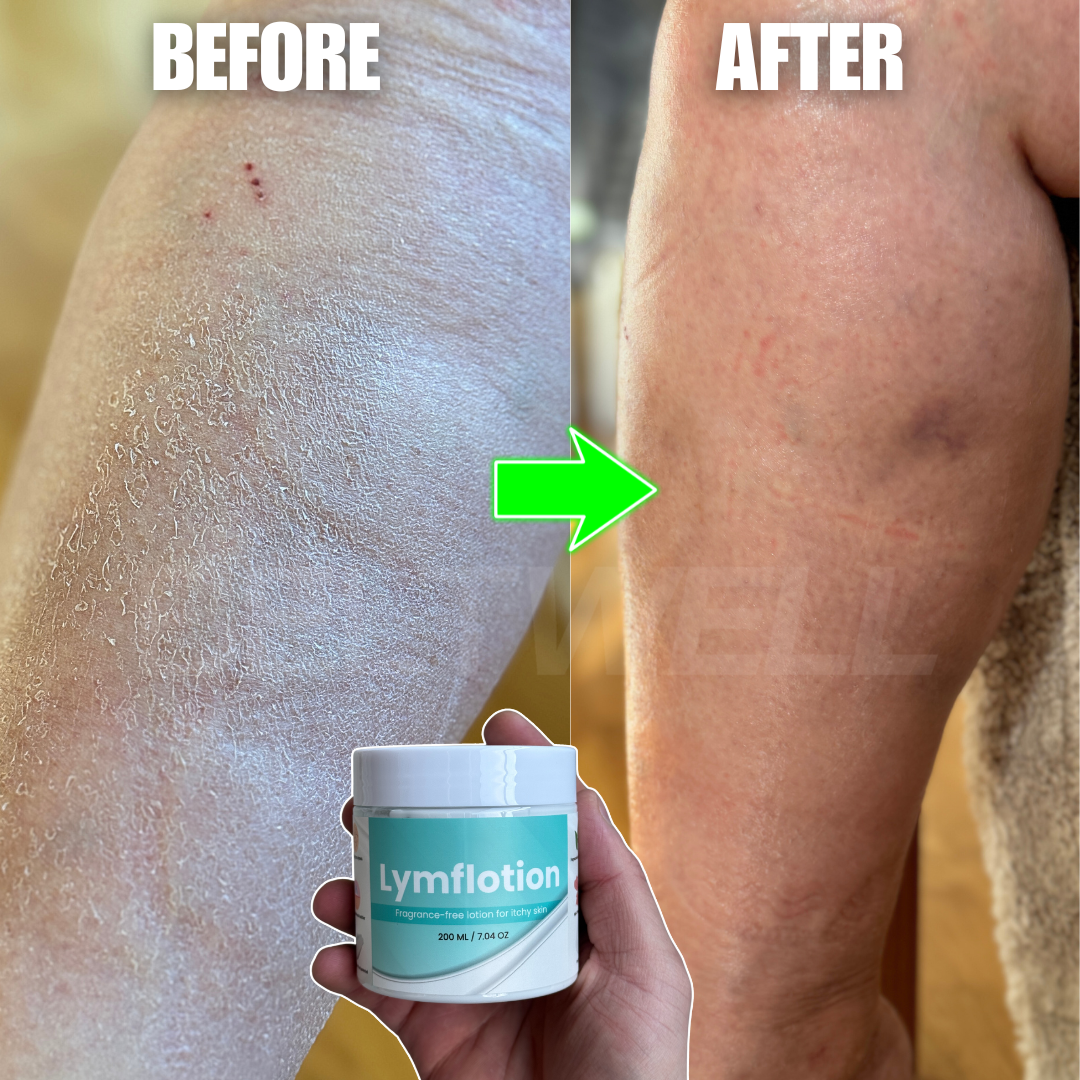 Fragrance-Free Non-Greasy Anti-Itch Ceramide NP Leg Lotion For Dry, Red, Sensitive, Discolored, Weeping