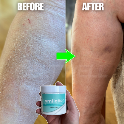Fragrance-Free Non-Greasy Anti-Itch Ceramide NP Leg Lotion For Dry, Red, Sensitive, Discolored, Weeping