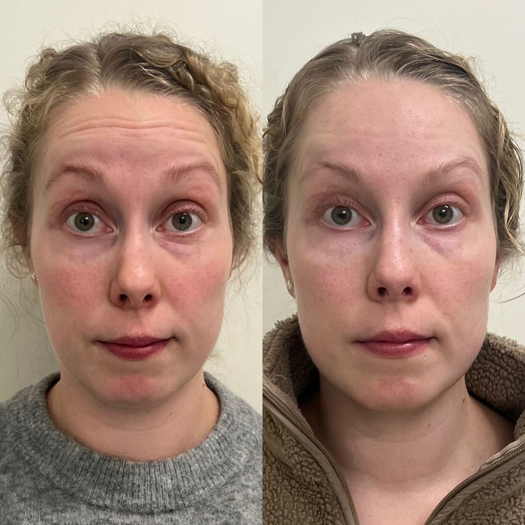 pt-574e7449fb2b-botox-otsaan-essi-ojala-1.jpg