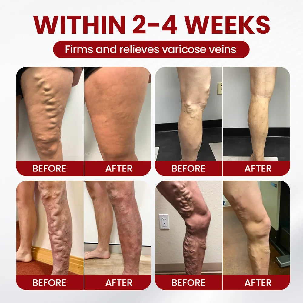 Varicose & Spider Vein Relief Cream